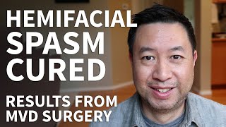 Hemifacial Spasm Surgery Recovery  Hemifacial Spasm Stories and MVD Surgery Cure [upl. by Yrogreg]