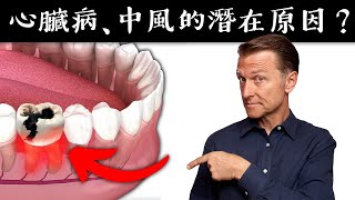 心臟病、中風的奇特原因 吃脂質維生素C自然療法柏格醫生 Dr Berg [upl. by Gil]