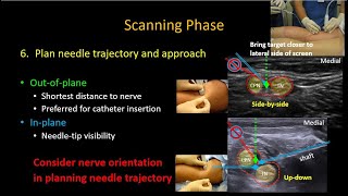 USguided Popliteal Sciatic Nerve Block [upl. by Frisse]