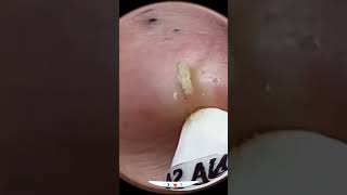 Blackheads Removal  Acne Treatment and Very Satisfying Satisfying Pimple pop blackheads [upl. by Edivad247]