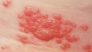 DermTV  Shingles  Herpes Zoster DermTV Epi 425 [upl. by Eseenaj]