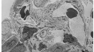 Understanding Membranoproliferative Glomerulonephritis Part 1 Hot Topic [upl. by Garlaand545]