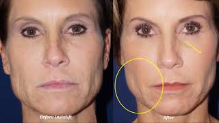 Instalift Nonsurgical Facelift Procedure [upl. by Zaccaria]