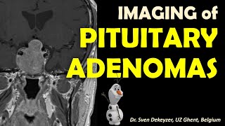 Imaging of Pituitary Adenomas [upl. by Almeda832]