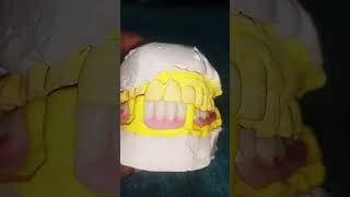 acrylic partial denture by HAMZA DENTA CRAMIC and idea art dentalimplant dentist dental [upl. by Enoyrt]