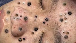 Big Cystic Acne Blackheads Extraction Blackheads amp Milia Whiteheads Removal Pimple Popping  1213 [upl. by Pieter]