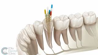 Endodontie  Wurzelbehandlung  City Dental Clinic Bratislava [upl. by Anaert]