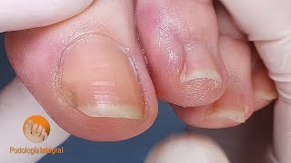 Growth control and routine nail cleaning Podología Integral [upl. by Primalia]