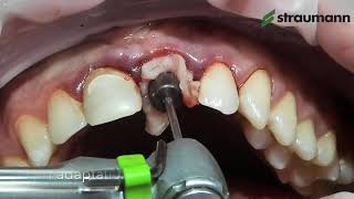 Straumann® BLX Immediate Incisor Placement and Loading Step by step overview [upl. by Stefa600]