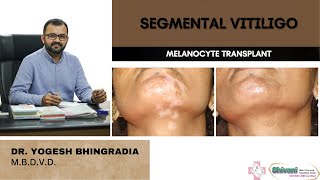 Segmental vitiligo  Melanocyte transplant surgery  Dr Yogesh Bhingradia [upl. by Hanafee]