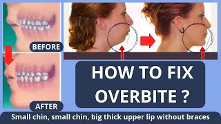 HOW TO FIX OVERBITE  SMALL CHIN BIG THICK UPPER LIP  WITHOUT BRACES NATURALLY [upl. by Annoyi66]