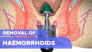 Removal of Haemorrhoids [upl. by Amand646]