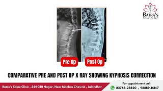 TB Spine With Paraparesis Improved After Surgery  LifeChanging Spine Surgery Success Story 13 [upl. by Alik]