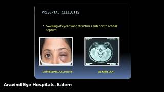 Adnexal amp Orbital Infections  Dr Viji Rangarajan AEHCBE [upl. by Tamas]