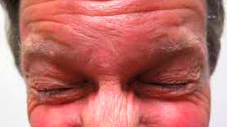 What is Blepharospasm Symptoms Causes Treatment [upl. by Etnelav]