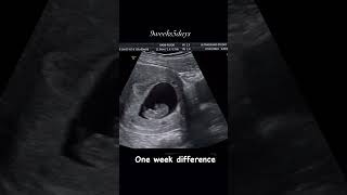 9 week baby movement in womb pregnancy ultrasound pregnancycare [upl. by Arney]