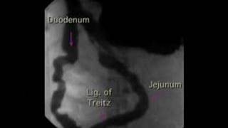 Lower GI Movies  Duodenal Peristaltic Waves [upl. by Alleynad799]