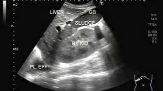 Ultrasound Video showing multiple findings in a patient attempting suicide by taking Kala pathar [upl. by Etak]