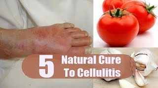 5 Home Remedies for Cellulitis  By Top 5 [upl. by Culbertson475]