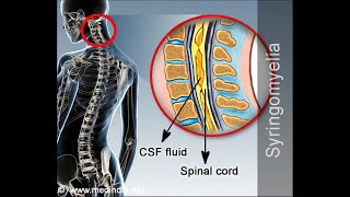 Neuroanatomical Reasons for Signs and symptoms in syringomelia Cavitation of the spinal cord [upl. by Zarla]