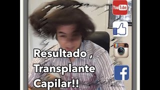 Resultado do meu Transplante capilar após 3 anos Natural e cabelos compridos [upl. by Dorweiler]