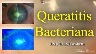 Queratitis Bacteriana [upl. by Ydualc]