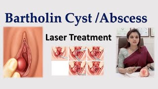 Bartholin Cyst  Abscess  Causes  Laser Treatment  DrDeepa Ganesh  Cosmetic Gynecologist [upl. by Unders]