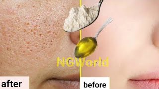 In just two days all the enlarged pores on your skin will disappearnarrow the enlarged pores [upl. by Lower]