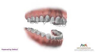 Orthodontic Retainer  Hawley  Instruction and Care [upl. by Atisusej706]