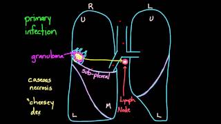 Primary and Secondary TB [upl. by Attenahs]