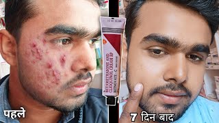 खराब चेहरा को मात्र 7 दिन मे ठीक करे  Betnovate C Cream Honest Review 2022 In Hindi  Betnovate c [upl. by Broucek]