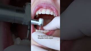 Enameloplasty  Filing Edges of Your Teeth w TheBracesDoc [upl. by Llewen]