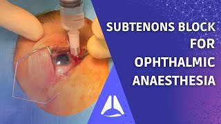 Subtenons block regional anaesthesia for ophthalmic surgery Live patient UPDATE [upl. by Lezned]