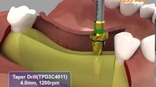 HIOSSEN OSSTEM ETIII System surgical procedures [upl. by Tseng586]