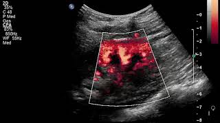 Echo Doppler Rénales Parenchymateuses [upl. by Arsi]