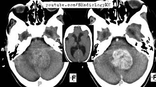 Case 115 A 6yearold boy presents with clumsiness and vomiting [upl. by Bunch]