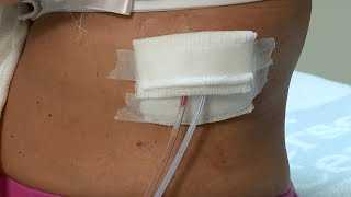 How to care for a postsurgery wound drainage system and gauze dressing [upl. by Alika]