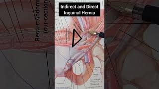 Indirect and Direct inguinal hernia  Anatomy [upl. by Oam]