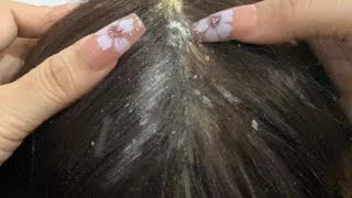 ASMR Satisfying Dandruff Removal and Scalp Check [upl. by Erastatus875]