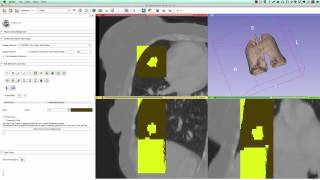 Segmentation of lung and nodule in CT using 3D Slicer [upl. by Alletnahs]