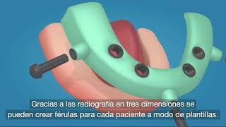 Cirugía guiada Implantes Dentales  Clínica Dental MiBO Almería [upl. by Atnohs4]