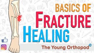 Fracture Healing  ANIMATION  BASICS  The Young Orthopod [upl. by Eveivenej]