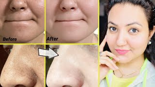 कितने भी मुश्किल Blackheads Whiteheads कील सफेद दाने हों follow करें ये 5 steps और पाएँ चमकदार skin [upl. by Isolde994]