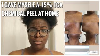 DIY 15 TCA CHEMICAL PEEL AT HOME  GET RID OF BODY ACNE  BEFORE amp AFTER  Barbara Atewe [upl. by Emmy575]