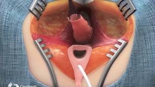 Surgical Treatment for Short Common Channel Cloaca – Posterior View  Cincinnati Childrens [upl. by Brittain898]