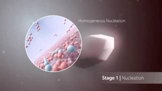 Kidney Stones in the Process of Formation in the Kidneys [upl. by Eitten]