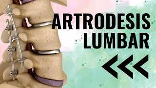 Lo que NADIE te dice de la ARTRODESIS LUMBAR 💡 Qué es EJERCICIO y SECUELAS tras OPERACIÓN [upl. by Llednil]