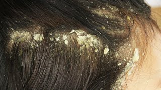 Dandruff scratching comb on head using black combing23 [upl. by Palla]