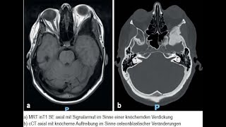 Osteodystrophia deformans Paget mit einseitigem Exophthalmus [upl. by Aihsemat]