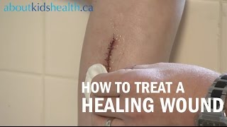 How to care for a healing wound [upl. by Nytsrik]